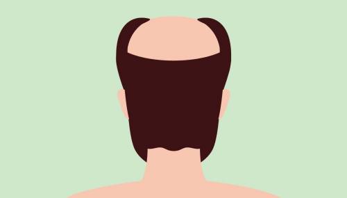 caida de pelo por estres solucion caida de pelo por estres solucion